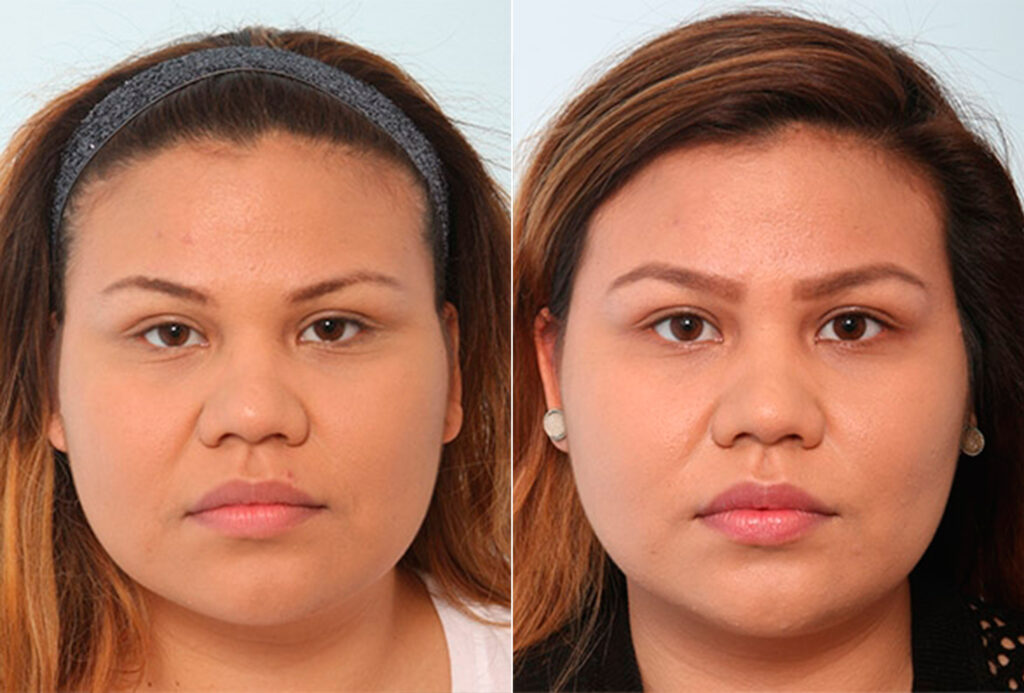 Buccal Fat Pad Removal Photos Houston Tx Patient