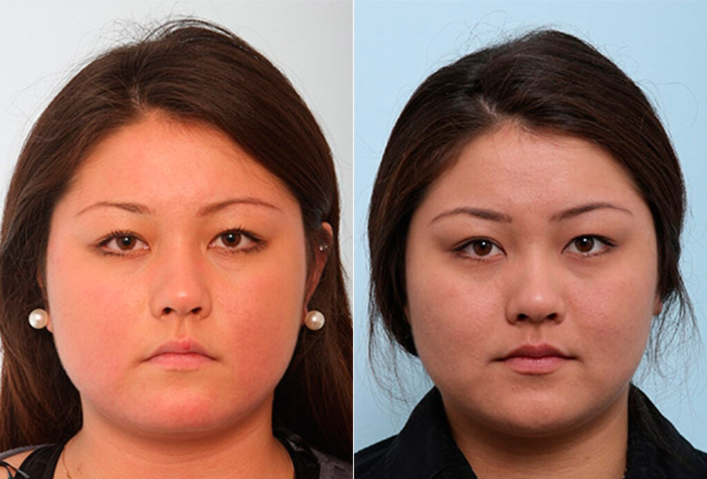 Buccal Fat Pad Removal Photos Houston Tx Patient