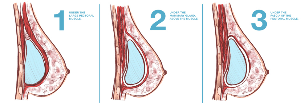 The section of breast in women: 1. Ribs, 2. Large chest muscle, 3.