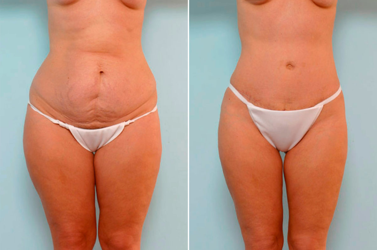 How to Get the Best Tummy Tuck Results