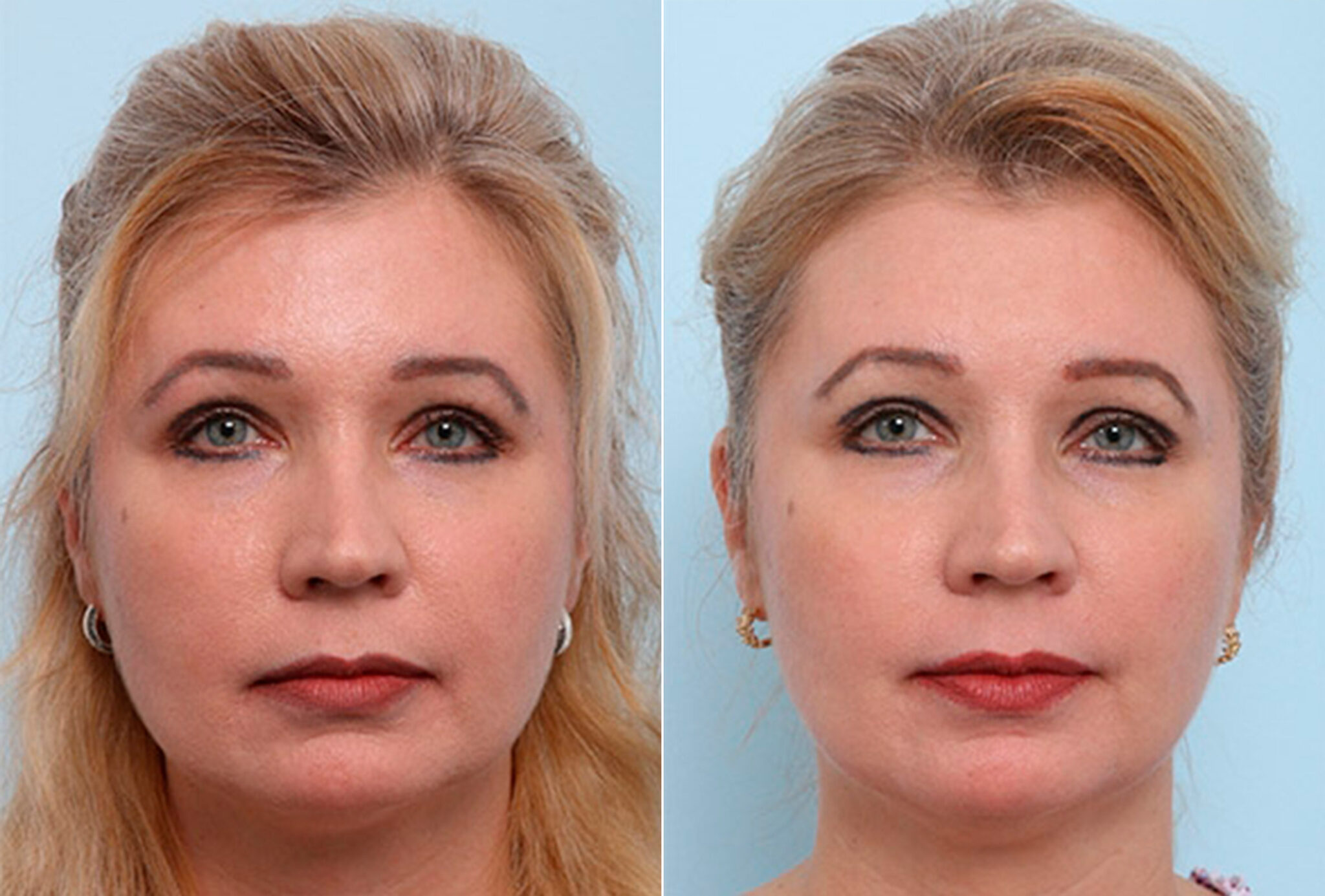 buccal-fat-pad-removal-photos-houston-tx-patient-27796