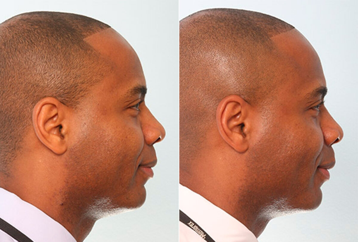 Buccal Fat Pad Removal Before and After