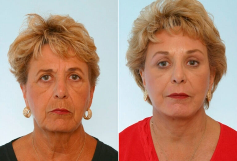 Facelift Photos Houston Tx Patient 28274   Before After 1781 768x520 