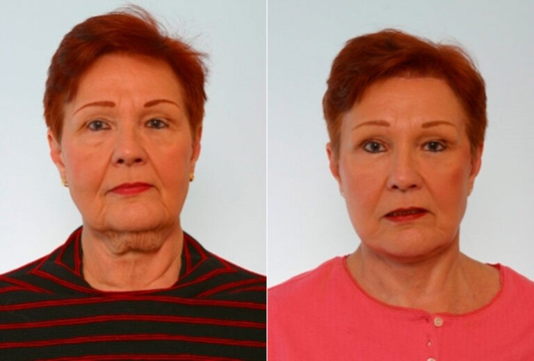 Facelift Photos Houston Tx Patient 28281   Before After 1784 768x520 