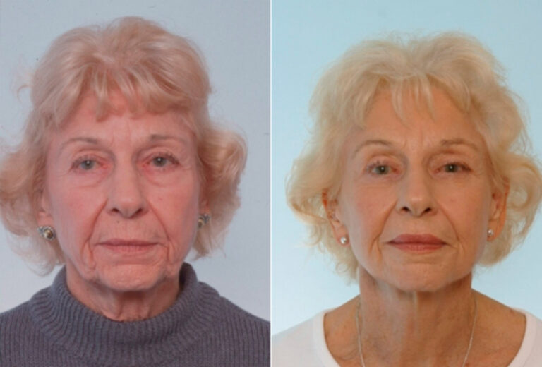 Facelift Photos Houston Tx Patient 28309   Before After 1796 768x520 