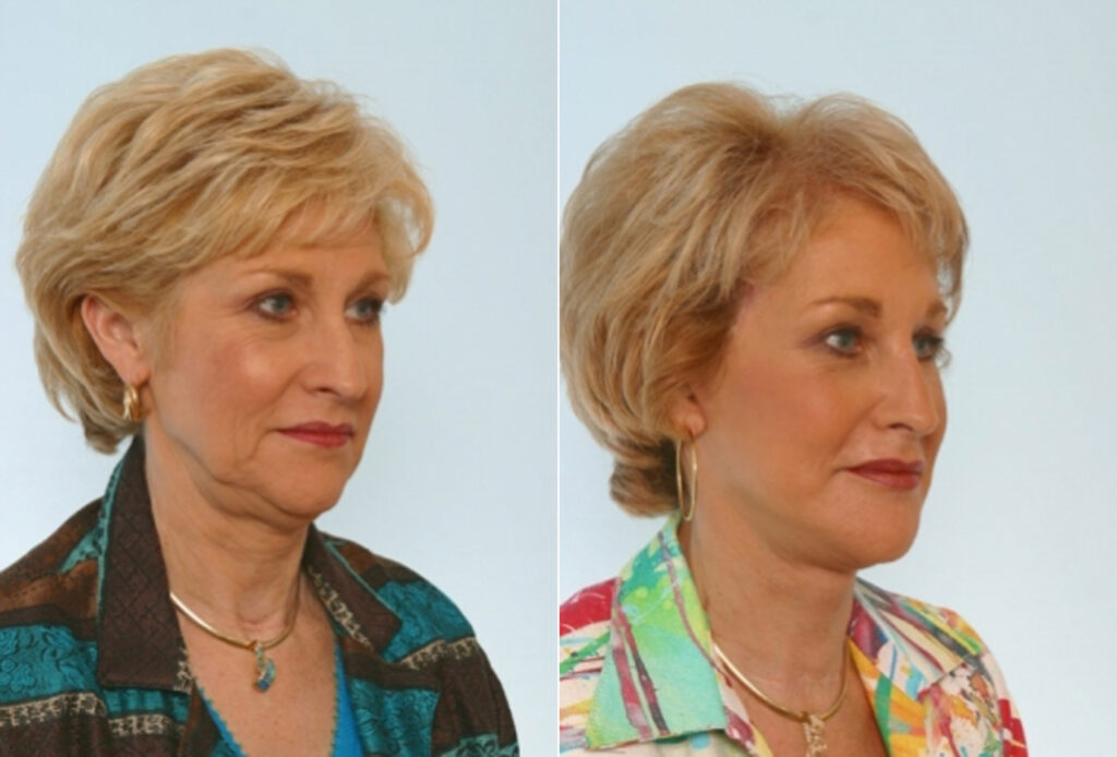 Facelift Photos | Houston, Tx | Patient 28395