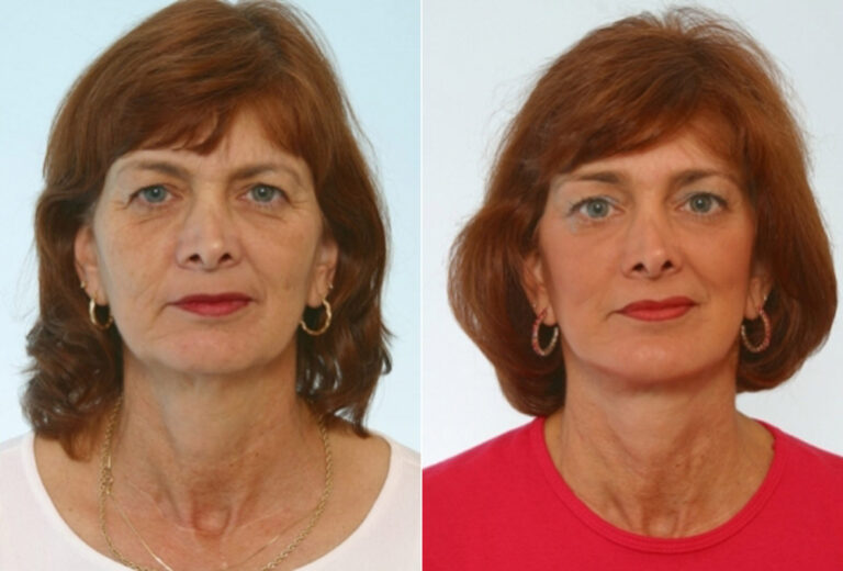 Facelift Photos Houston Tx Patient 28402   Before After 1836 768x520 