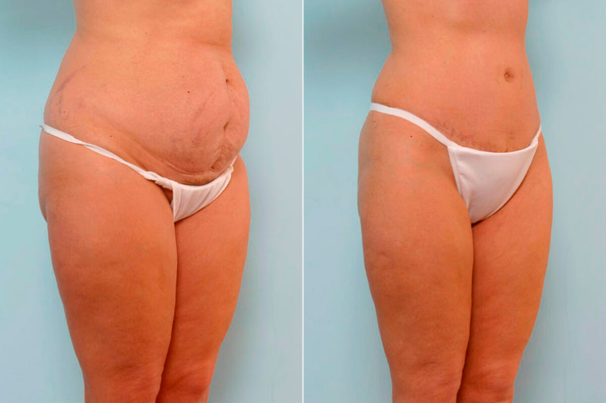The Truth About a Tummy Tuck: What They Don't Tell You - Blog