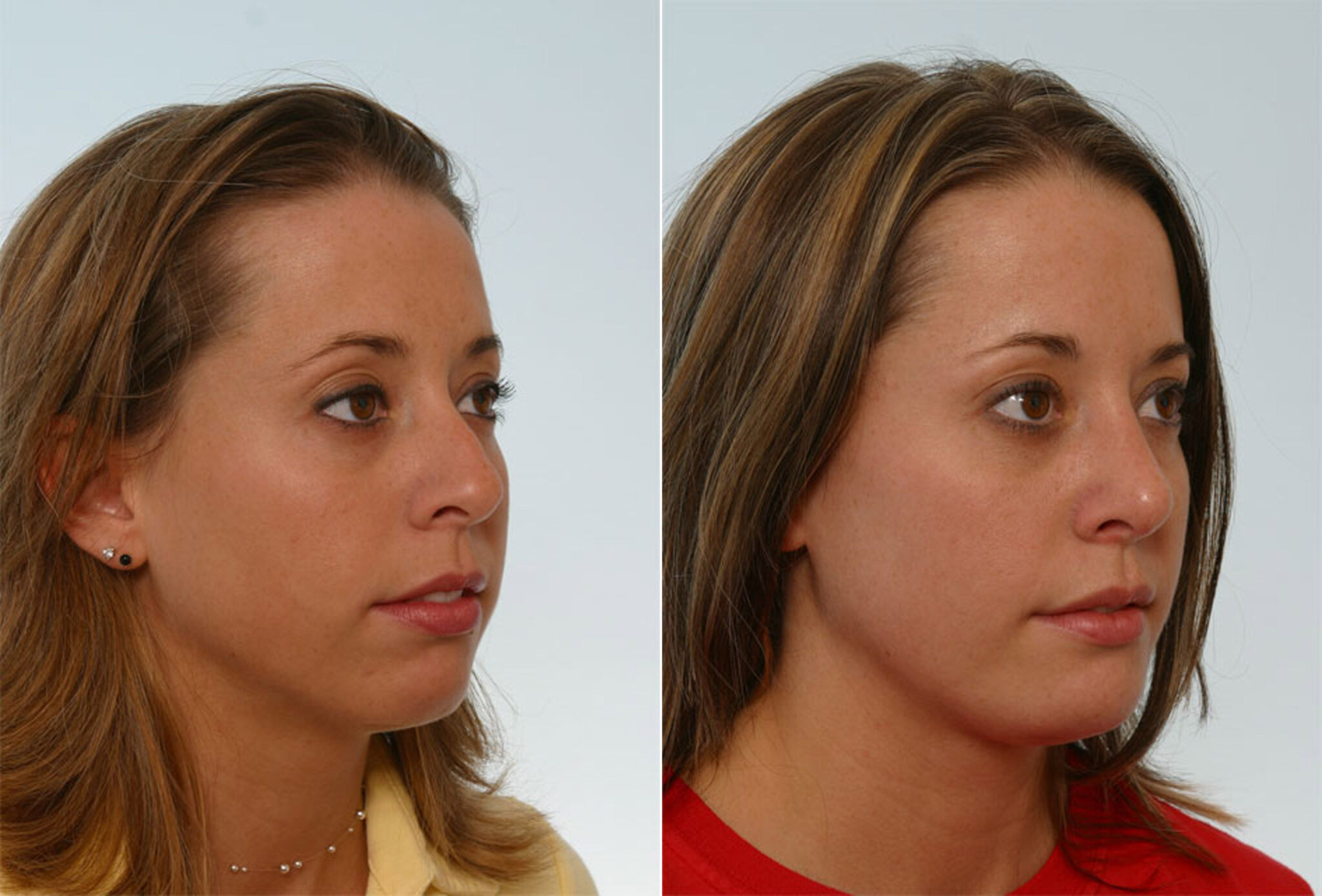 Rhinoplasty Photos Houston Tx Patient 29651 1908