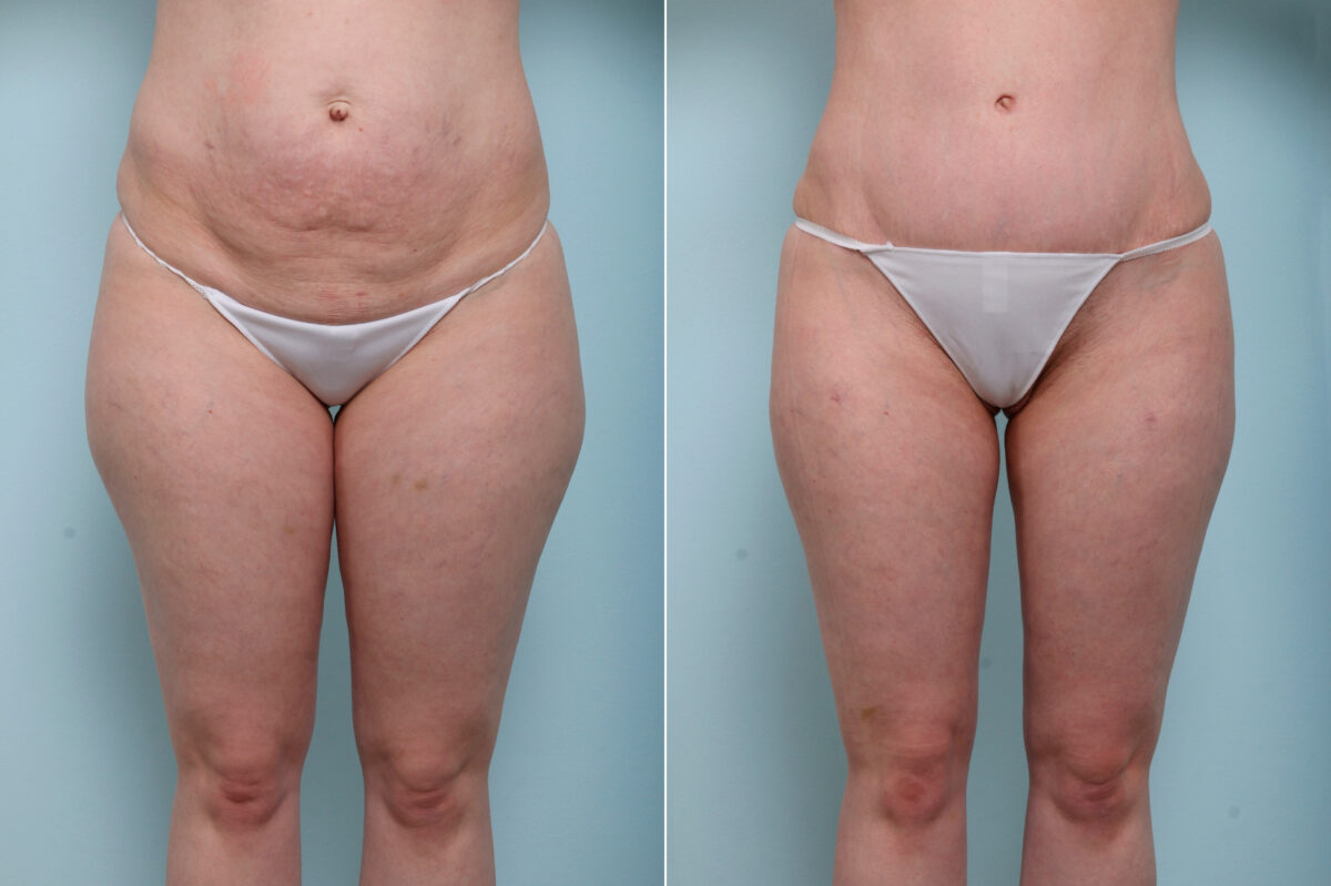 If that Post-Baby Bulge Won't Budge, a Tummy Tuck May Help