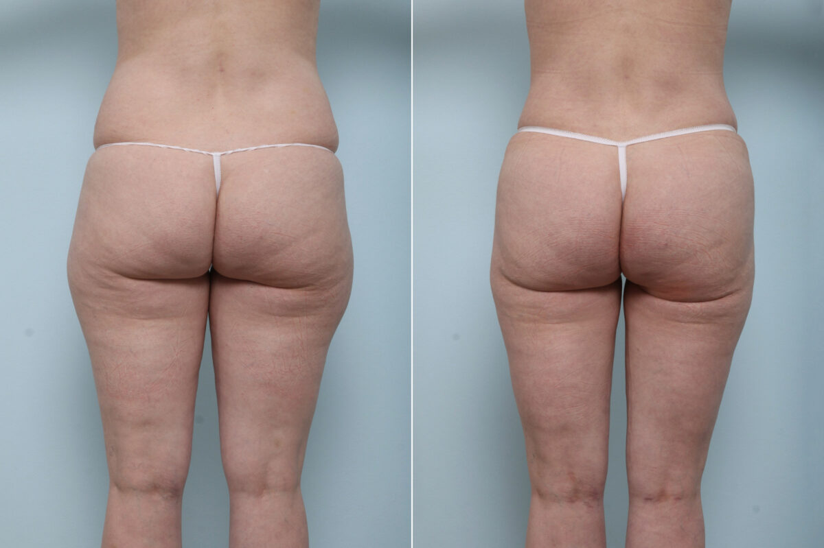 The Truth About a Tummy Tuck: What They Don't Tell You - Blog