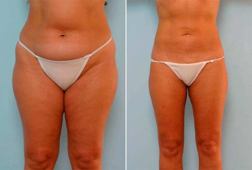 Liposuction 101: A Complete Guide for Beginners - Blog
