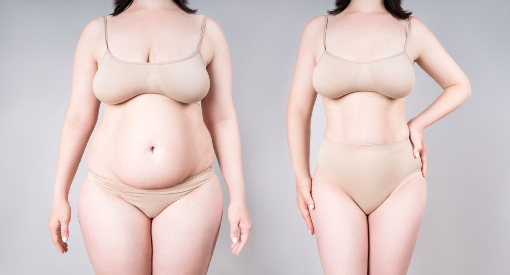 Liposuction After Care  What Not to do After Liposuction
