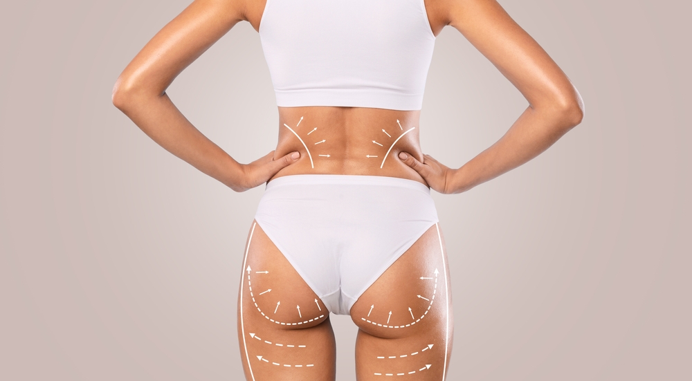 Lift up your lift with Buttock Augmentation Procedure