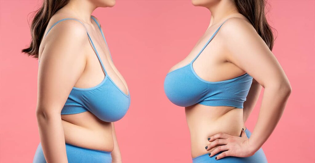 Breast Lift or Breast Implants?