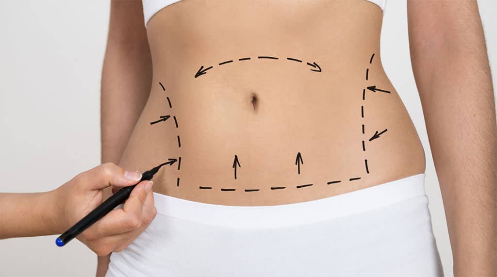 Common Tummy Tuck Side Effects - Dr. Brian J. Kobienia