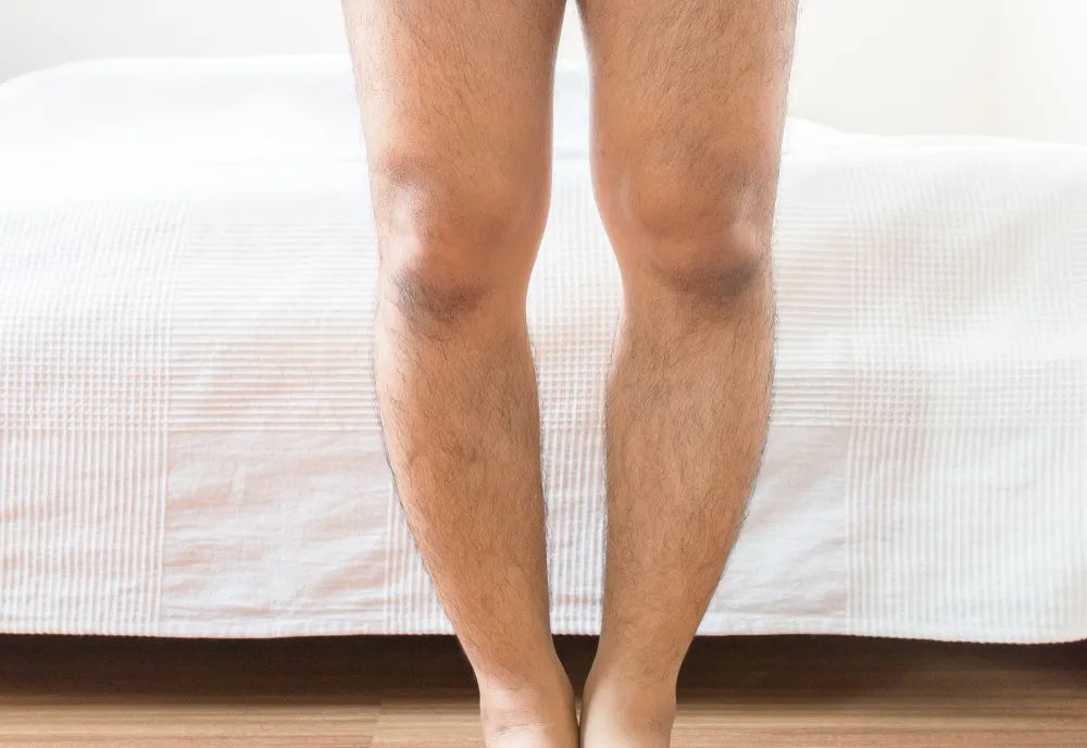 Post-calf-implant surgery results showing enhanced lower leg shape.