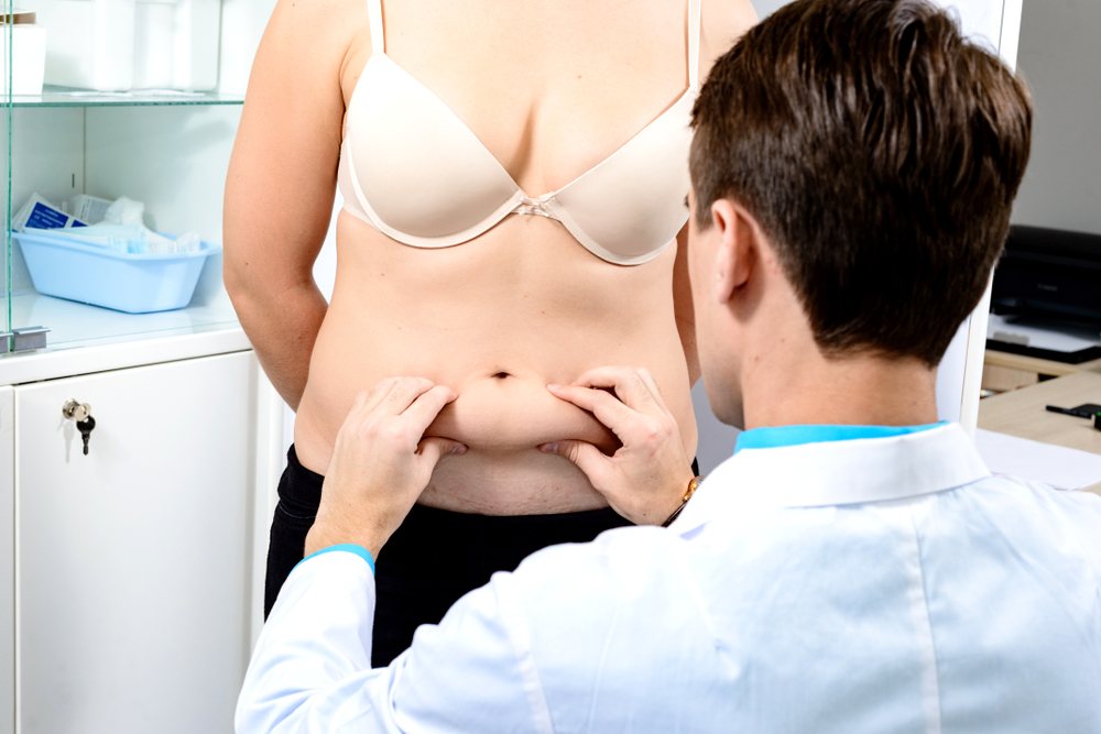 Doctor examining a patient’s abdomen, discussing revision liposuction options.
