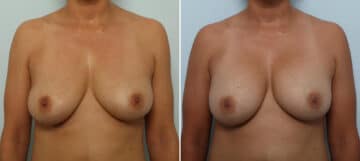 Breast Implant Removal before and after photos in Houston, TX, Patient 82917